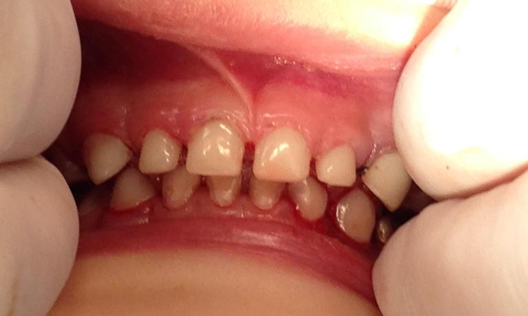 Pediatric-Dentistry-Restorative-Treatment-After-Image