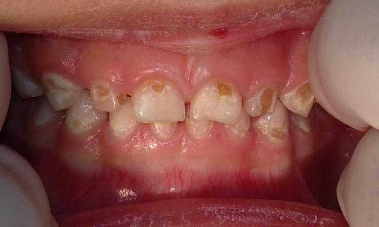 Pediatric-Dentistry-Restorative-Treatment-Before-Image